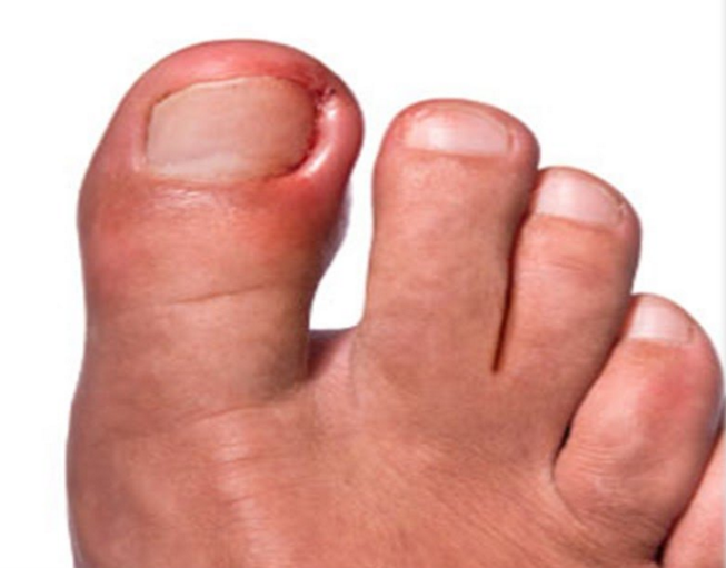 Especialización en Onicocriptosis Sin Dolor